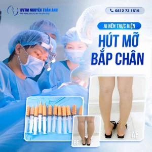 Ai nên thực hiện hút mỡ bắp chân?