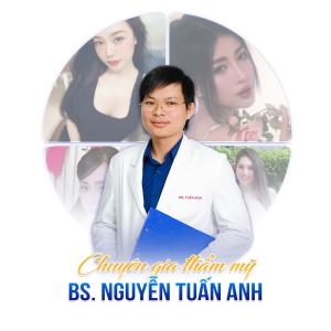 Nâng mũi sụn surgiform – dáng mũi cao tự nhiên