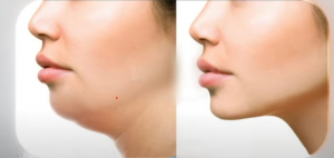 Giải pháp nâng cơ bằng chỉ collagen