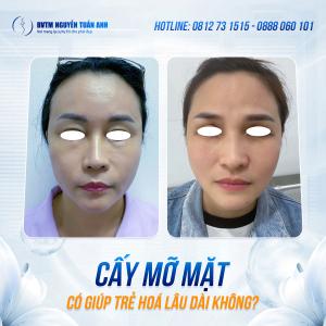 Cấy mỡ mặt có giúp trẻ hóa lâu dài không