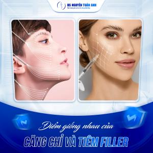 So Sánh Căng Chỉ Và Tiêm Filler