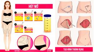 Tạo hình thành bụng khác gì hút mỡ bụng?